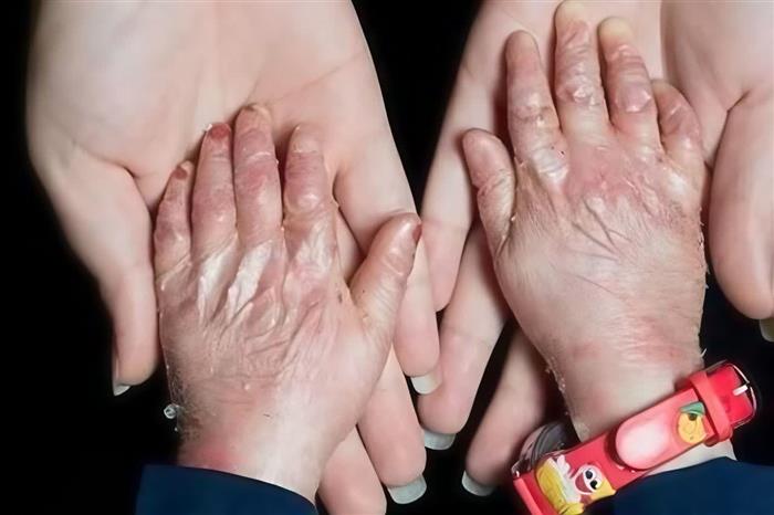 مدیرعامل انجمن بیماریهای نادر کرمان؛ هزینههای سرسامآور و محدودیت دسترسی به دارو، زندگی بیماران نادر را سختتر کرده است مدیرعامل انجمن بیماریهای نادر کرمان؛ هزینههای سرسامآور و محدودیت دسترسی به دارو، زندگی بیماران نادر را سختتر کرده است